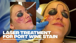 Treating a PortWine Stain with Excel V Laser at Contour Dermatology [upl. by Mellisent]