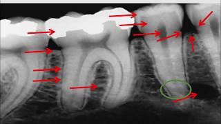 Radiographie rétro  alvéolaire [upl. by Valentino]