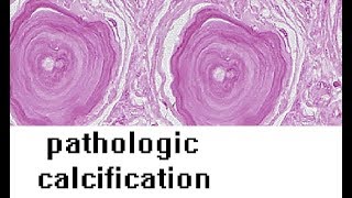 PATHOLOGIC CALCIFICATION [upl. by Finlay]