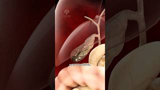 Gallbladder removal surgery  Open Cholecystectomy shorts gallbladder  creativelearning3d [upl. by Bose]