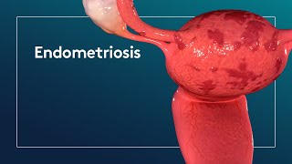 What is Endometriosis [upl. by Iblehs902]