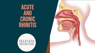 CHRONIC RHINITIS part 3 atrophic rhinitis important seq easy explanation [upl. by Owena]