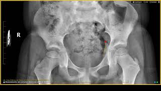 LeggCalvéPerthes disease on XRay  Cartilage Injuries amp Abnormalities [upl. by Fang]