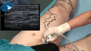 Preoperative marking of a borderline atrophic Great Saphenous Vein GSV [upl. by Leith187]