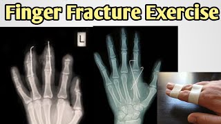 finger fracture exercises  phalanges fracture exercises  finger fracture physiotherapy  in hindi [upl. by Aneloaup]