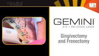 Gingivectomy and Frenectomy for Orthodontics  How to Use the Gemini™ Laser [upl. by Farmann]