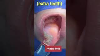 Hyperdontia shorts ytshorts viral teeth shortvideo [upl. by Niroht]