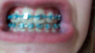 After the 13th tightening to my braces possibly the last [upl. by Ibson]