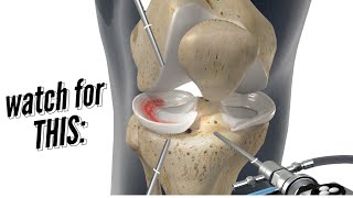 Meniscus Repair vs Meniscectomy [upl. by Ximena]