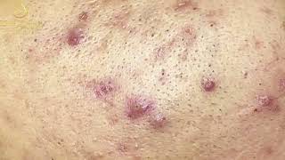 Loan Nguyen Acne Treatment 00174 [upl. by Enovahs]