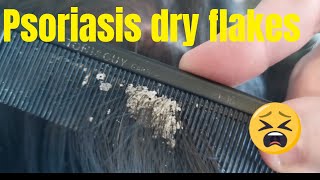 Scalp psoriasis removal  painful dry flakes [upl. by Sheree387]