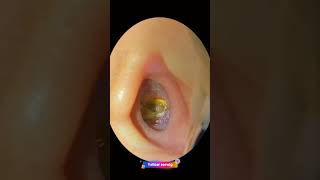 Ear wax removal  Take earwax  Relaxing videos [upl. by Talich210]