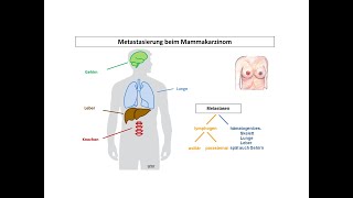 Metastasierung beim Mammakarzinom  Strahlentherapie Prof Hilke Vorwerk [upl. by Eraste]