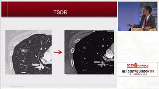 Treatment Strategy for Ground Glass Opacity and Tiny Lung Nodules [upl. by Cutty]