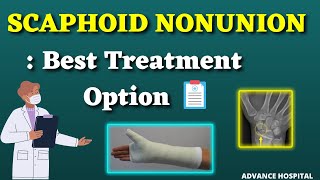 Best Treatment for NonUnion of Scaphoid bone Dr Prathmesh Jain [upl. by Nnovahs]