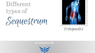 Types of Sequestrum in less than 3 mins [upl. by Artenahs813]