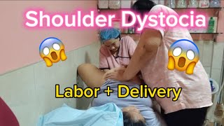 Shoulder Dystocia  Shoulder stuck on the Mother pubic symphysis  Normal Delivery [upl. by Aivitnahs418]