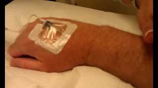 IVIG Infusion Procedure part 2  Treatment for Stiff Person Syndrome [upl. by Leonidas]