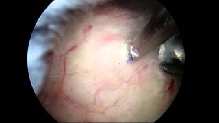 Arthroscopic removal of calcium deposit from shoulder calcific tendonitis [upl. by Secnarf]