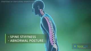 Ankylosing Spondylitis Symptoms [upl. by Kirstyn]