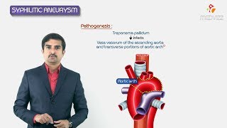 Syphilitic aneurysm  ascending aorta amp arch or aorta   Pathology Usmle step 1 Fmge and Neet Pg [upl. by Jermayne]