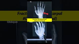 Fracture 5th Metacarpal ⚡️Xray Hand xray radiographerusn radiography shorts [upl. by Hamilah]