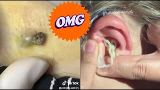 Blackhead Popping Extravaganza Satisfying Skin Care Moments [upl. by Kasey]