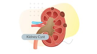 All About Health  Kidney Cyst 大愛醫生館  腎臟水汪汪 [upl. by Kylila78]