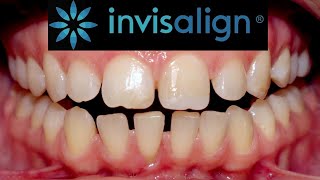 INVISALIGN time lapse Treatment of 7 MONTHS Incisor proclination [upl. by Benedicta]