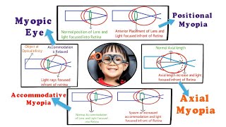 Myopia  Introduction and Etiology within 3 min 15 [upl. by Booker]