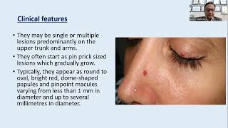 Lecture194 Telangiectasias Hemangiomas and Arteriovenous malformations Rooks Chapter 103 [upl. by Carmena663]