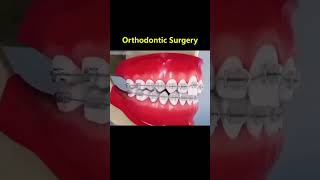 Ortho Treatment open bite العلاج التقويم للعظه المفتوحه 🎖️👌 [upl. by Eldwon]