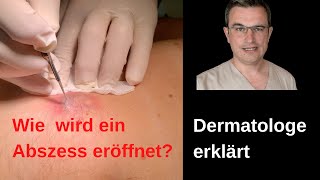 Dermatologe kommentiert Öffnen einer infizierte Zyste mit Abszess drkasten abszeß [upl. by Eelegna]