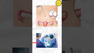 Vasectomy or Tubectomy difference [upl. by Eseela]