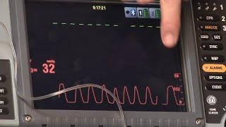 Waveform Capnography [upl. by Notgnilra326]