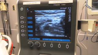 Ultrasound Guided Intravenous Access [upl. by Arjan]