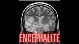 ENCEPHALITE [upl. by Niassuh419]