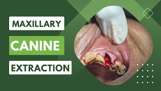 Upper Canine  Maxillary Canine Extraction dentistry [upl. by Yoshiko960]