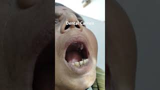 Dental abscess  Dental Carries [upl. by Johnsten771]