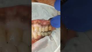 Lateral interferences checking for lower jaw molar implant bridge shorts [upl. by Aninad57]