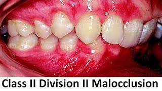 Can Class II Division II of Malocclusion Be Treated With Orthotropics by Prof John Mew [upl. by Elwaine8]