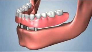 edentulismo completo opciones fija total sobredentaduraflv [upl. by Borer]