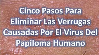 Remedios Caseros Para Eliminar Las Verrugas Causadas Por El Virus Del Papiloma Humano [upl. by Nniuqal427]