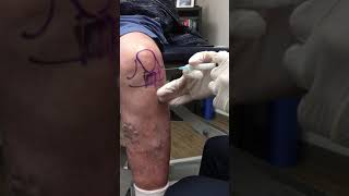 Anterior Knee Injection  Elite Sports Medicine  Lethbridge [upl. by Dola]