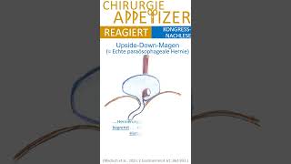 CHIRURGIE APPetizer REAGIERT Upside Down Stomach vs Thoraxmagen [upl. by Eillime]