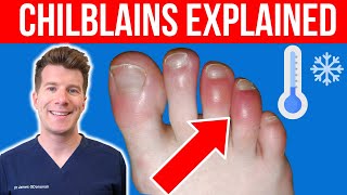 Doctor explains CHILBLAINS Pernio  Causes symptoms and treatment [upl. by Manvil]