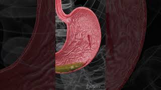 Understanding Hemorrhagic Gastric Ulcers anatomy meded 3danimation [upl. by Maxama]