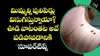 పులిపిర్లు ఎటువంటి నొప్పి లేకుండా రాలిపోయే ఉత్తమ చిట్కా మీ ఇంట్లోనే Remedies for Warts Pulipirlu [upl. by Scopp]