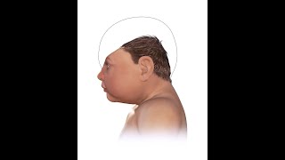 What is Microcephaly Causes Symptoms Treatment [upl. by Leopoldine]