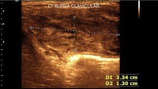 Supraclavicular lymphadenopathy  Cervical lymph node anatomy  Sonographic Appearance variation [upl. by Eigroeg377]